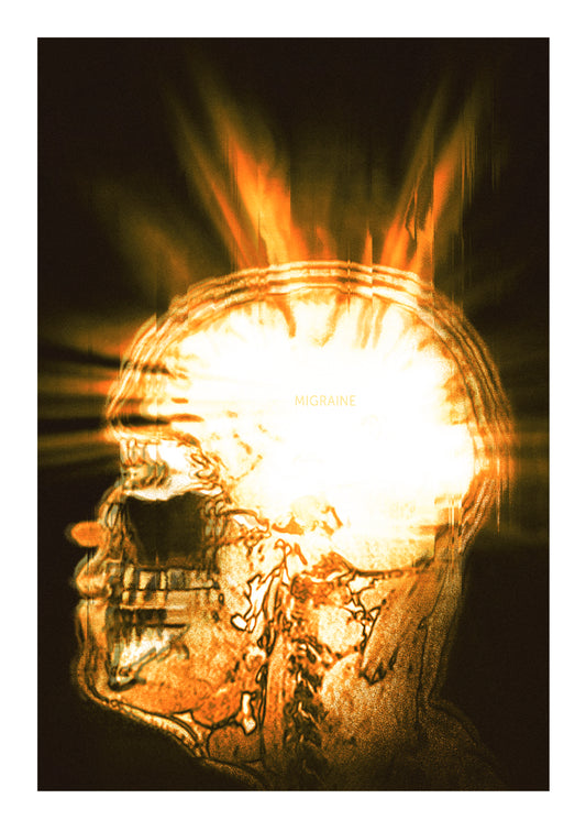 MIGRAINE